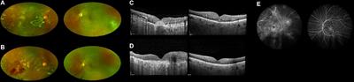 Case report: Intravitreal methotrexate in intraocular acute lymphoblastic leukemia